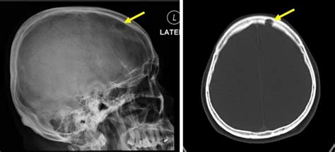 Lytic Skull Metastasis Radiology Cases