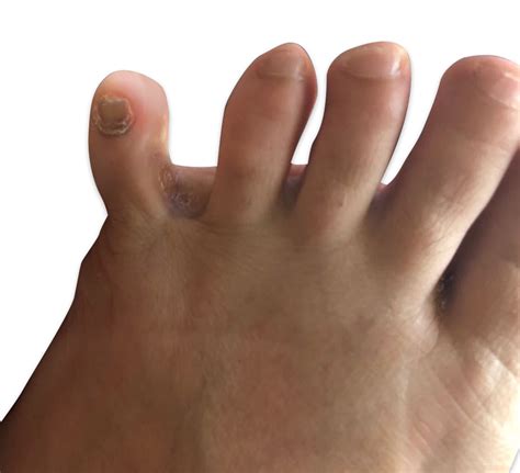 Corns Of The Feet And The Different Types Dubai Podiatry Centre