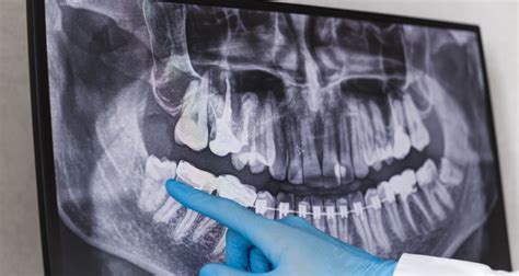 I myself faced this 4 times in my life; When Can I Eat Solid Food After Wisdom Teeth? - Eat Better ...