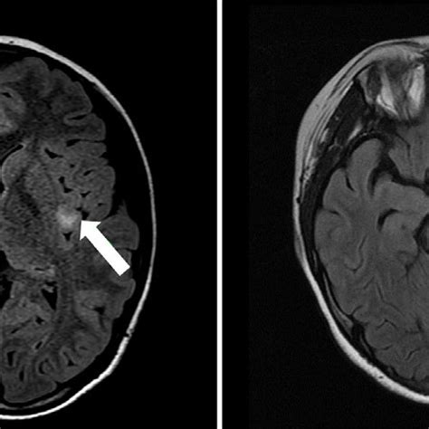 Magnetic Resonance Imaging Mri Findings The Initial Axial Fluid