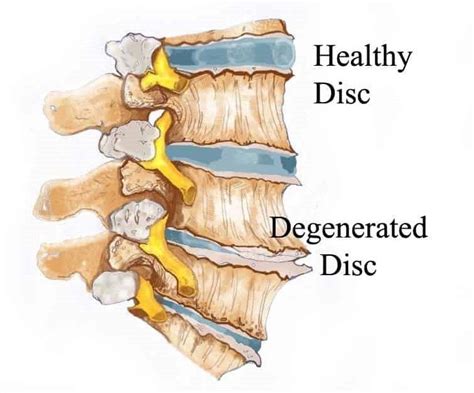 Stages Of Degenerative Disc Disease Neck