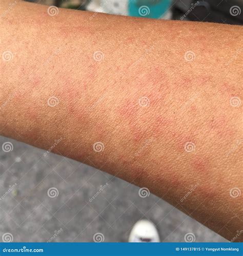 Sweat Allergy Rash Allergic To Sweat Symptoms Aep22