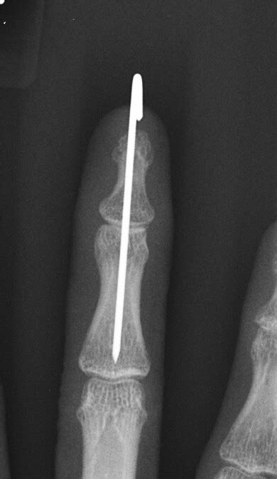 Mallet Finger Dropping Fingers Repair Surgery Houston Tx