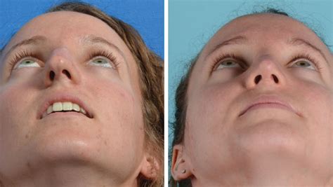 Crooked Nose Before And After Rhinoplasty Nose Surgery Photos
