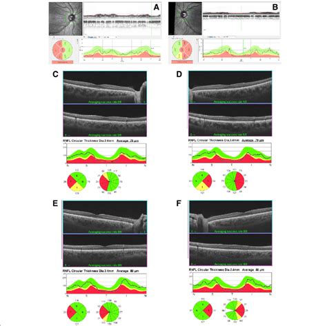 Optical Coherence Tomography Oct Of The Retinal Nerve Fiber Layers