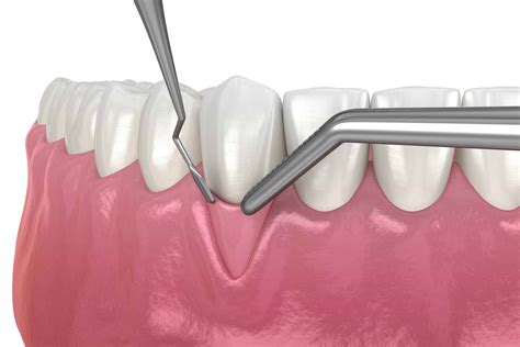 Toronto Gum Graft Services Protect Your Gums And Teeth