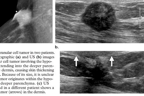 Figure 2 From Distinguishing Breast Skin Lesions From Superficial