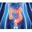 Colon Cancer Breakthrough Could Lead To Prevention  The Foods That Can