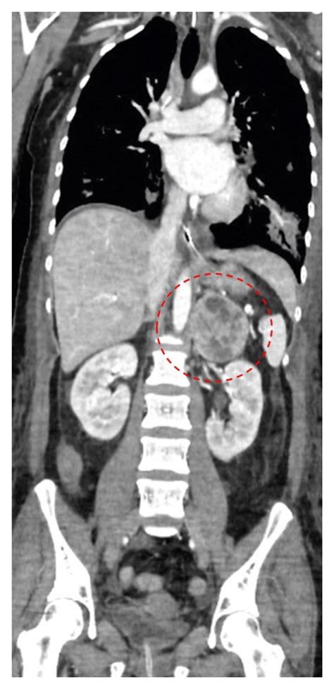 Contrast Enhanced Total Body Ct Scan Revealing A Left Adrenal
