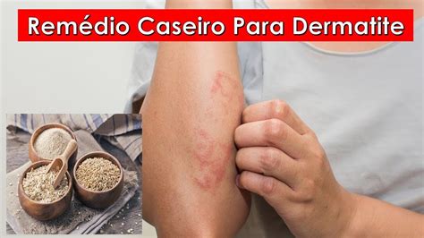 Remédio Caseiro Para Dermatite Dermatite Dermatite Atopica YouTube