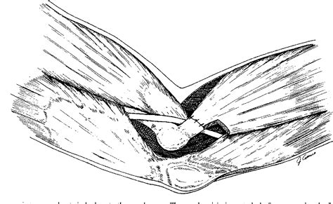 Figure 2 From Anterior Submuscular Transposition Of The Ulnar Nerve For