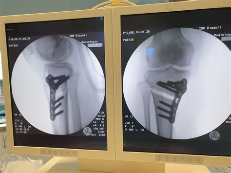 Understanding The Benefits And Risks Of High Tibial Osteotomy Orthoscape