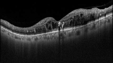 What A Diabetic Needs To Know About Diabetic Macular Edema Neoretina