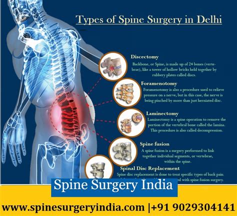 How Many Types Of Spine Surgery In Delhi Are Available