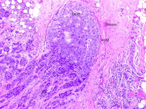 Ductal Carcinoma In Situ Histology