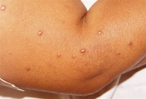 Sarcoidosis - Pictures, Symptoms, Prognosis, Causes, Treatment