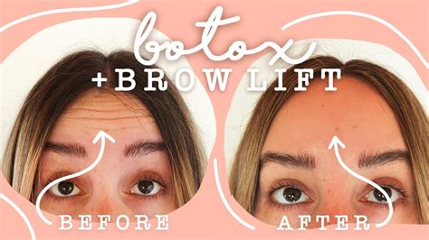 Botox Brow Lift What You Need To Know About Eyebrow Lift Botox