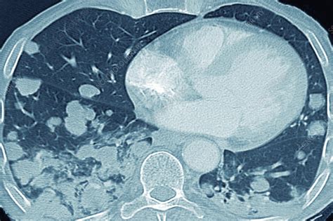 Lung Metastases Ct Scan Stock Image C0555051 Science Photo Library