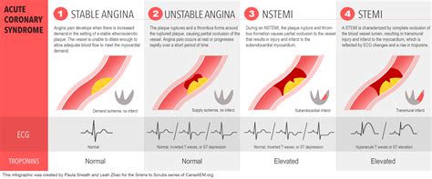 Sirens To Scrubs Acute Coronary Syndromes Part One Beyond Door To