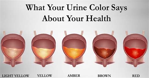Blood in the urine (hematuria) can make urine appear pink, red, or brown, depending on the amount of blood, how long it has been in the urine, and people with hematuria may have other symptoms of urinary tract disorders, such as pain in the side or back (flank), lower abdominal pain, an urgent. Learn What The Color Of Your Urine Means | Pee color ...