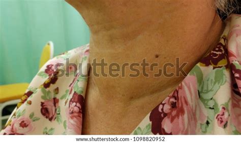 Examination Multinodular Goitre Elderly Lady Stock Photo 1098820952