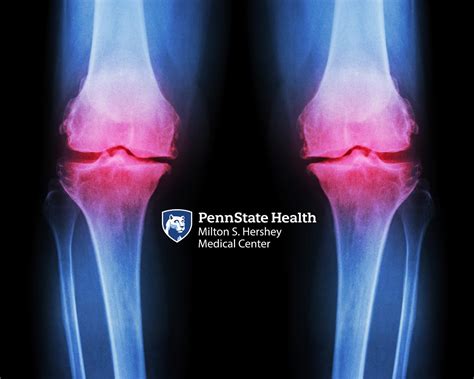 Preventing Knee Problems Penn State Health Medical Minute By Penn