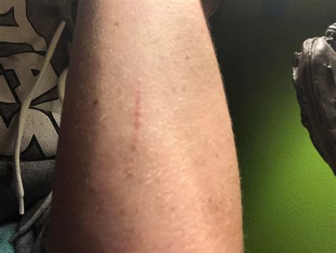 Line Of Very Small Bumps On Arm Not Itchy Or Painful Just Noticed It