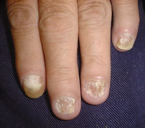 Distal Subungual Onychomycosis Caused By Candida In A Download