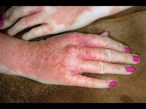 This includes positive events such as getting married, buying a house, going to college. Eczema Home Treatment for Hands : Dyshidrotic Eczema ...