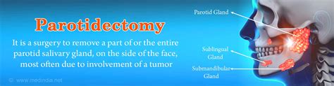 Parotidectomy Glossary