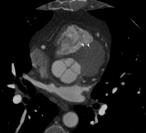 Mobile and tablet users, you can download on appstore or googleplay. Coronary Artery Anatomy - CT - Anterior Septal Arteries | Heart