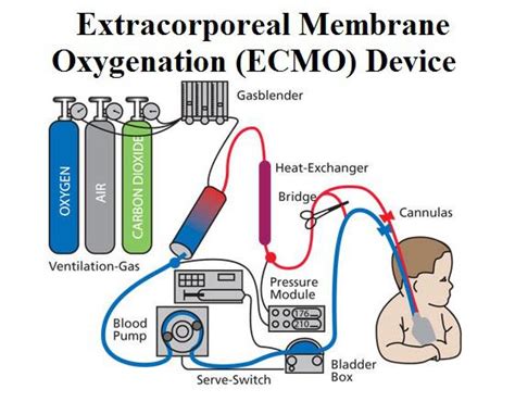 Ecmo is a procedure used in severe cases. Trending 2020 Extracorporeal Membrane Oxygenation Machine ...