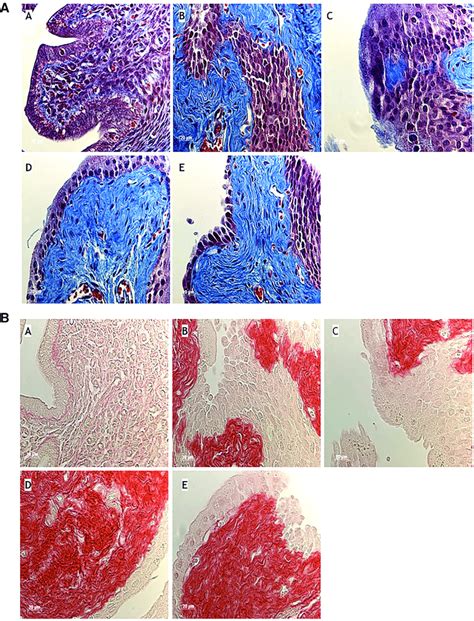 Fibrosis Histology After Trichrome A And Sirius Red B Staining Of Download Scientific