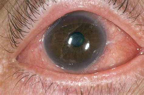 Allergic Conjunctivitis Of The Eye Stock Image C0085730 Science