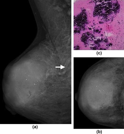 The Mammography And Mri Manifestations Of Adenomyoepithelioma Of The