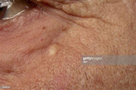 Sebaceous Cyst Under The Right Orbitary Of The Eye ニュース写真 Getty Images