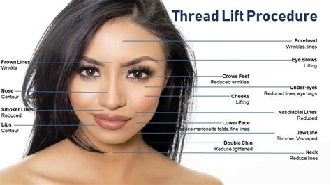 The pdo thread lift procedure safely and instantly lifts up loose skin on the face, neck and the body with minimal downtime.* thread lift is one the most novathreads are hypodermic needles preloaded with a synthetic pdo absorbable suture. Thread Lift - SPADE Skin Care
