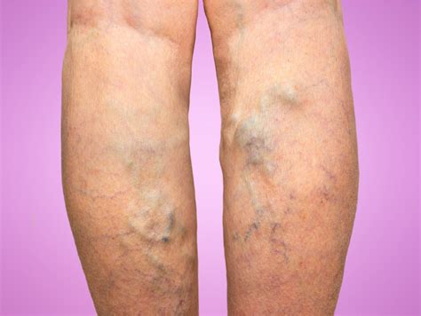 But, they can be uncomfortable and spider veins, a milder type of varicose veins, are smaller than varicose veins and often look like a. Top Guide of Varicose Veins - reliablecounter blog