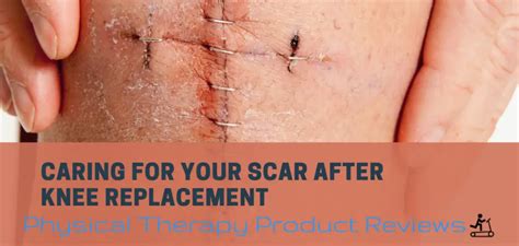 Caring For Your Scar After Knee Replacement Best Physical Therapy Product Reviews