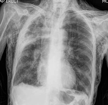 Surgical Emphysema Summary Radiology Reference Article