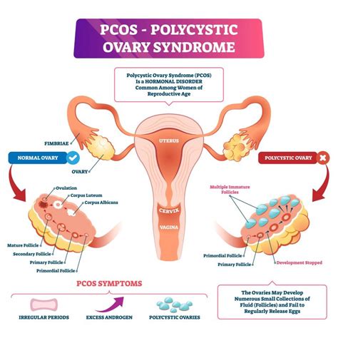 Endometriosis Vs PCOS A Helpful Guide Icy Health