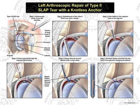 Left Arthroscopic Repair Of Type II SLAP Tear With A Knotless Anchor