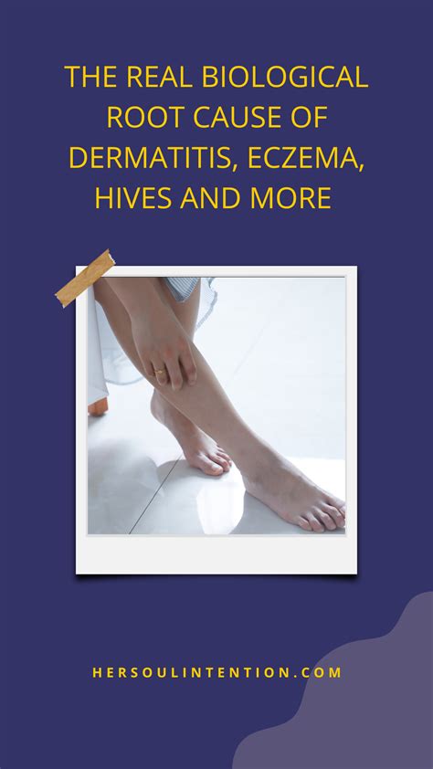 The Biological Root Cause Of Dermatitis Eczema Hives And More Her
