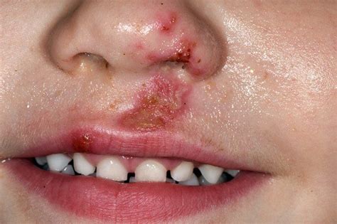 Guide To Contagious Rashes Skin Problems Fever Blister Skin Treatments