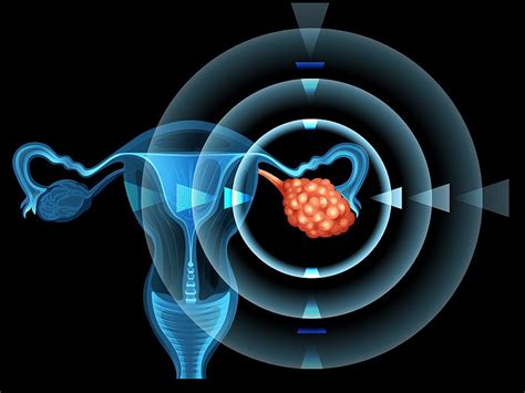 The Fatal Attraction Of An Ovarian Cancer Test