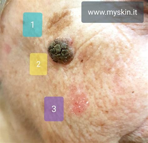 Tumori Della Pelle Come Riconoscerli Myskin Dermatologi Online