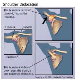 Recovery is possible, but often the injured. What is a dislocation? - WebMD Answers