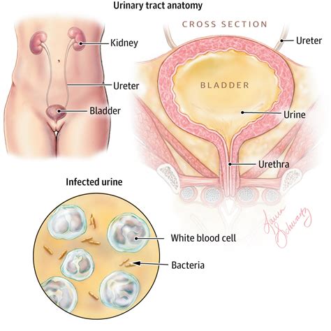 Urinary Tract Infections In Older Women Geriatrics Jama Jama Network