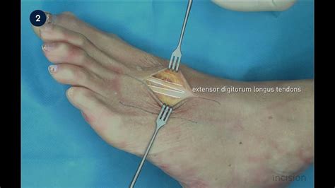 Foot Fasciotomy Youtube