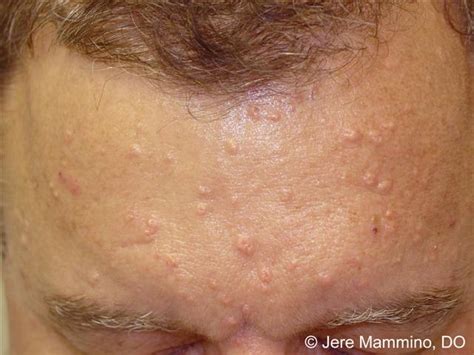 Sebaceous Hyperplasia American Osteopathic College Of Dermatology Aocd